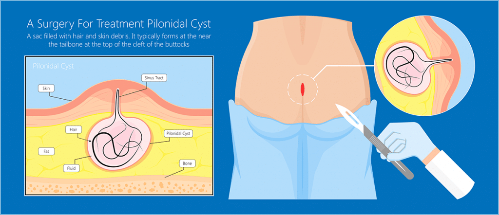What is a pilonidal cyst?